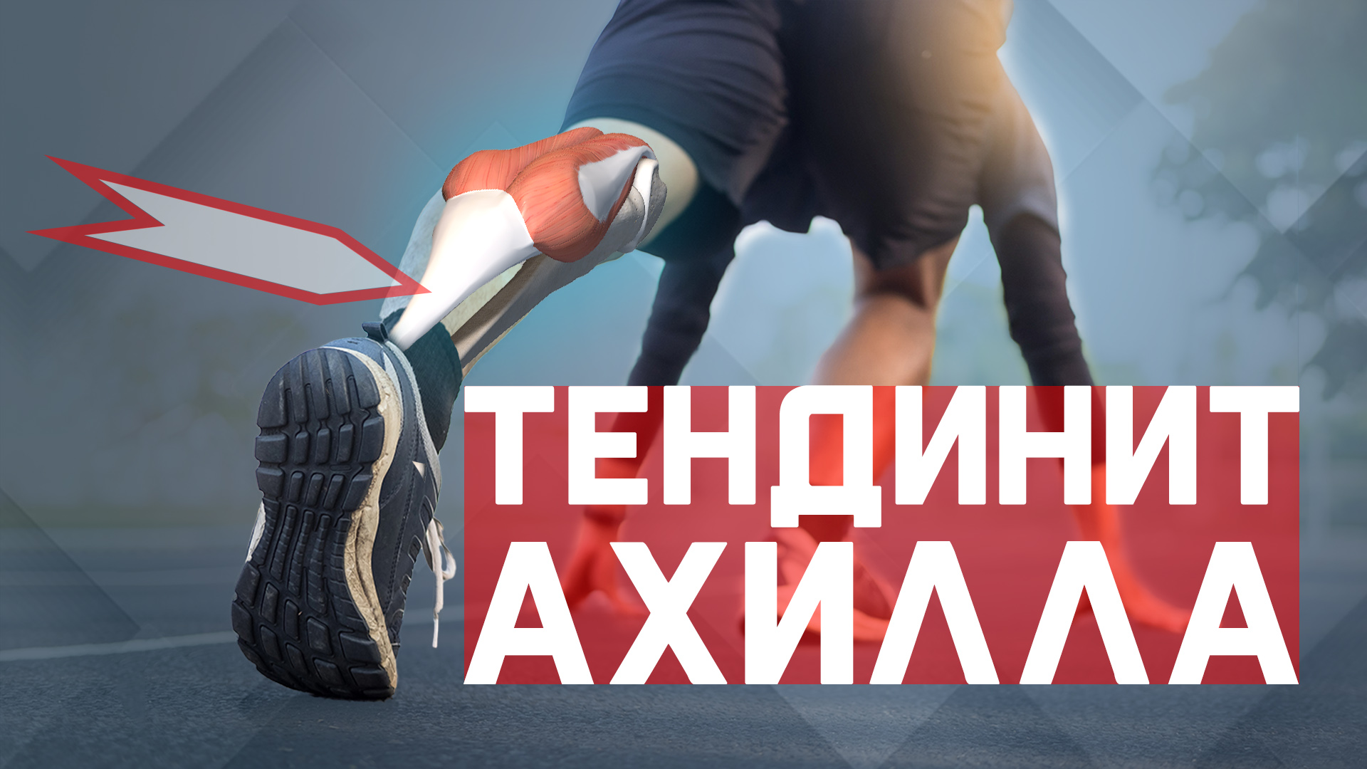 Тендинит Ахиллова сухожилия? Болит голеностоп? смотреть онлайн