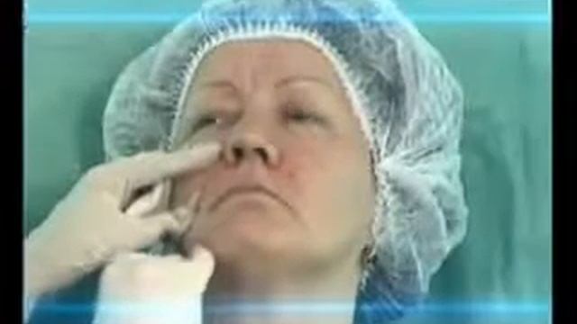 Носогубные Складки Малышева О Красоте И Уходе смотреть онлайн