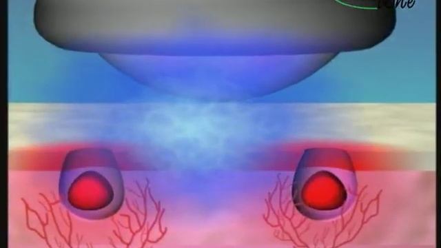 Обзор Family doctor от Gezatone - дорсонваля с функцией ИК-прогрева смотреть онлайн