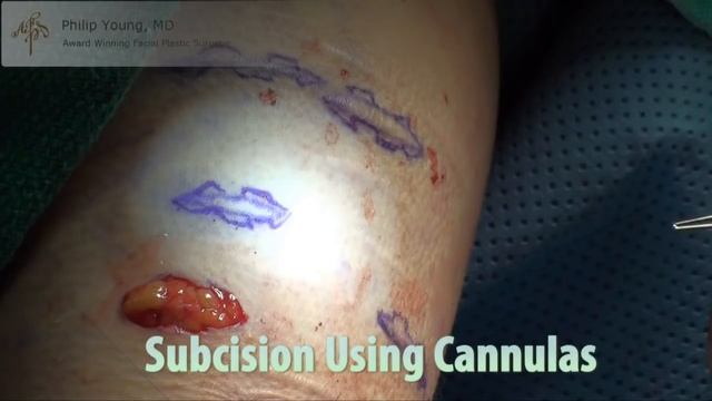 Acne Scar Vitalizer Treatment by Dr. Philip Young смотреть онлайн