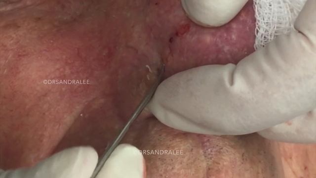 A Goldmine Of Blackhead & Whitehead Extractions