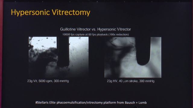 AIOC2020 IC567 T1 Dr Simar Rajan Singh New Toys on the Block – Instrumentation for Vitreoretinal Su смотреть онлайн