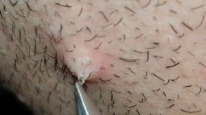 ВРОСШИЙ ВОЛОС!!!