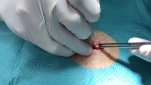 Операция  Удаление атеромы жировика.mp4