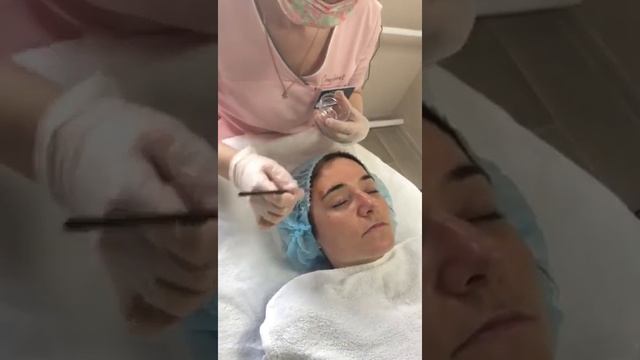 Миндальный пилинг