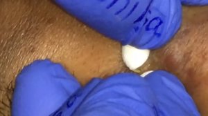 Blackheads Extractions on our Surprise Friend