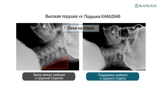 Ортопедические подушки KANUDA® vs обычные подушки смотреть онлайн