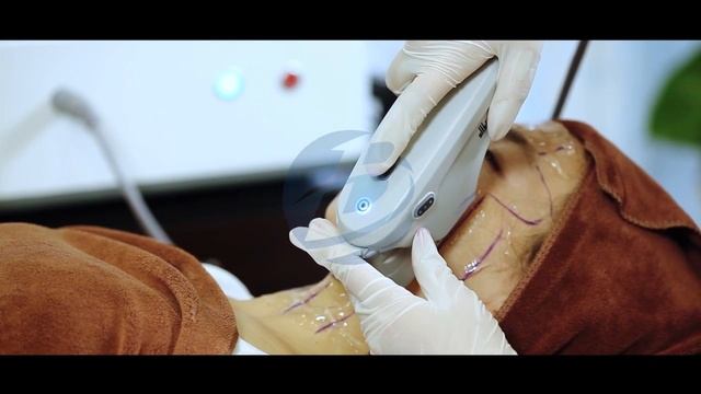 Operation Video For BESTVIEW HIFU Facial Lifting Machine.