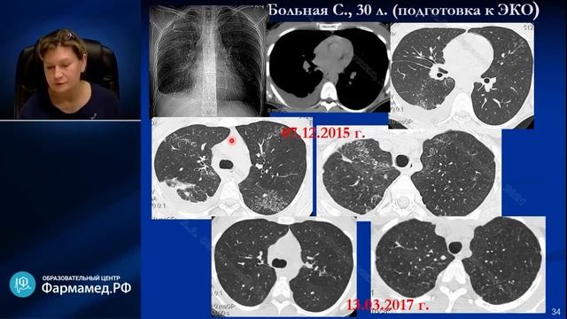 Профессор Сперанская А А Лучевая диагностика туберкулеза органов дыхания смотреть онлайн