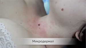 Микродермал – установка в яремную ямку | Пирсинг Самара