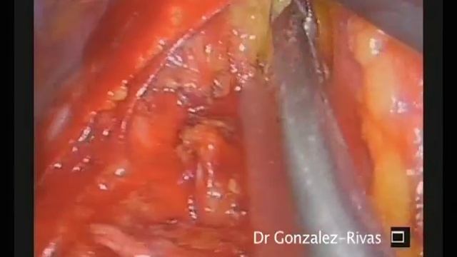 Paratracheal lymph node dissection by single port VATS (real speed, not edited, 7 minutes) смотреть онлайн