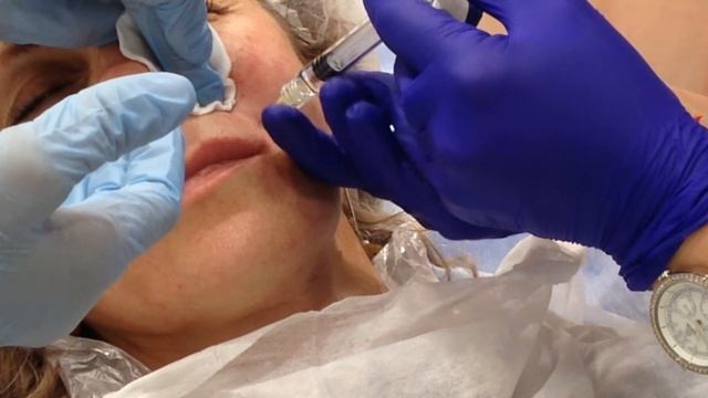 АирисКом: студенты учатся. Практика ботокс и биоревитализация: средняя часть лица смотреть онлайн