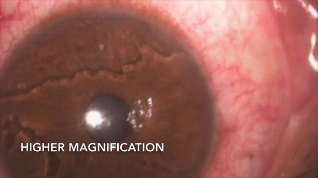 Corneal Foreign Body Removal And Debridement