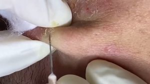 Relaxing Acne Treatment Acnes Treatment  73