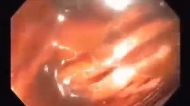 Кишечник. Видео изнутри.