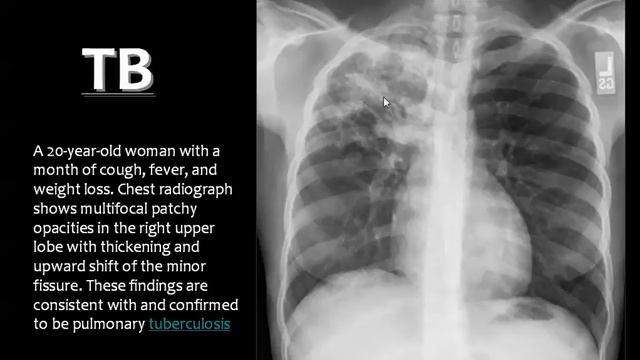 Imaging of pulmonary TB - DRE 7 - Dr Mamdouh Mahfouz смотреть онлайн