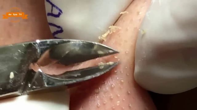 Удаление прыщей с носа и щек Spa #073 смотреть онлайн