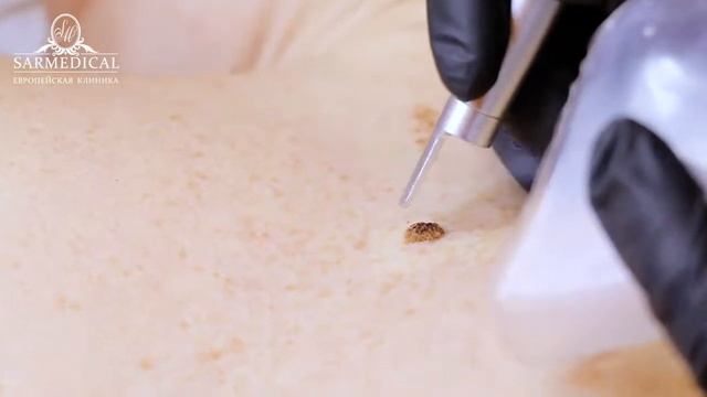 Удаление новообразований в Sarmedical смотреть онлайн