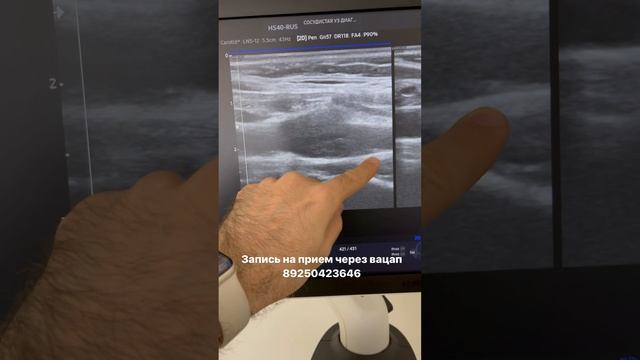 Атеросклероз сонных артерий. Высокий риск инсульта. Узи сосудов. Сосудистый хирург. Флеболог Москва смотреть онлайн