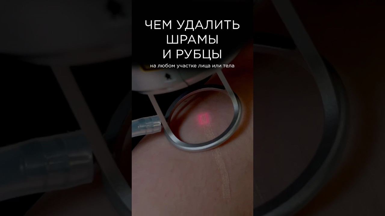 Коррекция шрамов и рубцов СО2 лазером #co2лазер #удалениешрамов смотреть онлайн