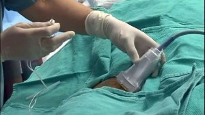 Проводниковая анестезия бедренного нерва