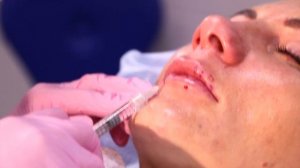 Демонстрация процедуры увеличение губ филлером
