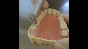 Препарирование зуба 1 класс по Блэку  Пломбирование стеклоиономерным цементом