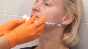 Аириском: применение БОТОКСА в области носогубной складки, ноздрей и для поднятия кончика носа.