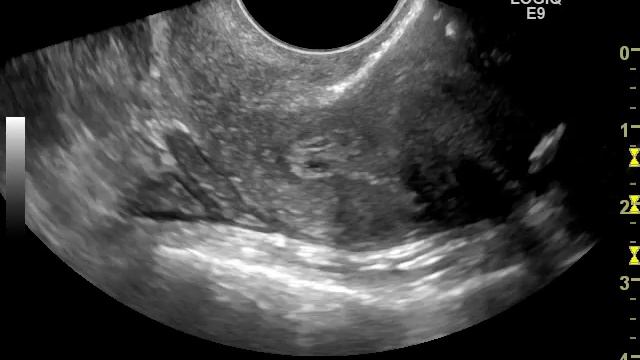 Патология эндометрия. Миома матки. Двурогая матка. смотреть онлайн