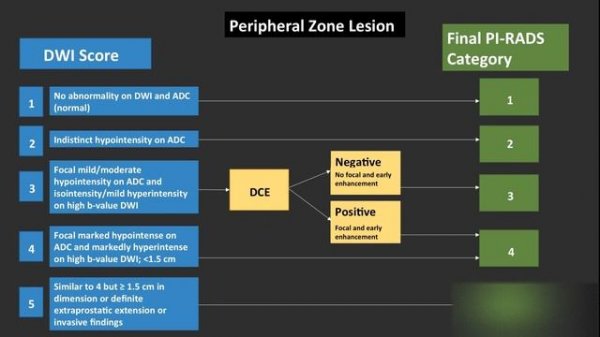 Multiparametric Prostate MRI for Prostate Cancer and PI RADS v2