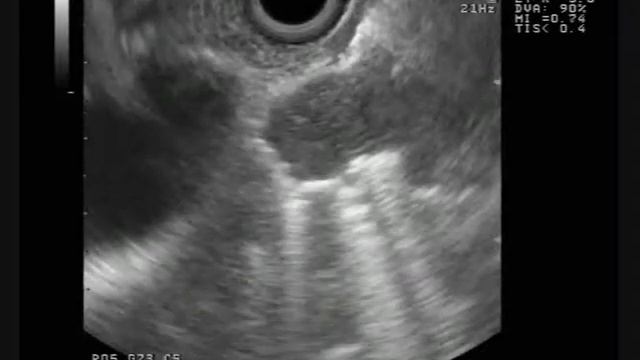 Mediastinum lymph node metastasis after breast cancer resection смотреть онлайн