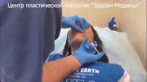 Увеличить губы с помощью инъекции гиалуроновой кислоты