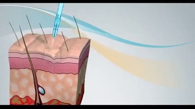 Jet Peel Technology смотреть онлайн