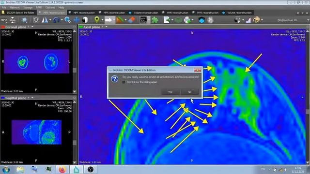МРТ . ИМПЛАНТЫ . ОПУХОЛЬ . смотреть онлайн