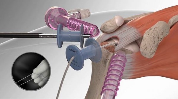 Восстановление надостной мышцы плеча