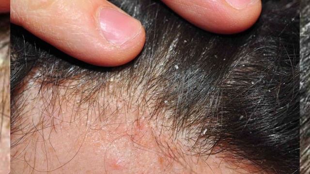 Псориаз: фото начальной стадии на руках, ногах, теле и голове смотреть онлайн