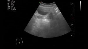 УЗИ малого таза (трансабдоминальное исследование)