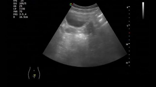 УЗИ малого таза (трансабдоминальное исследование)