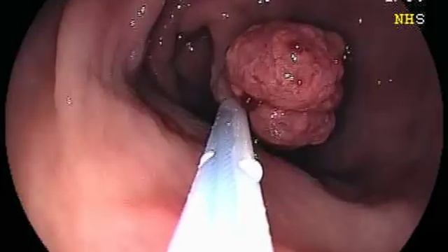 Endoscopic Stomach Polyp Removal смотреть онлайн