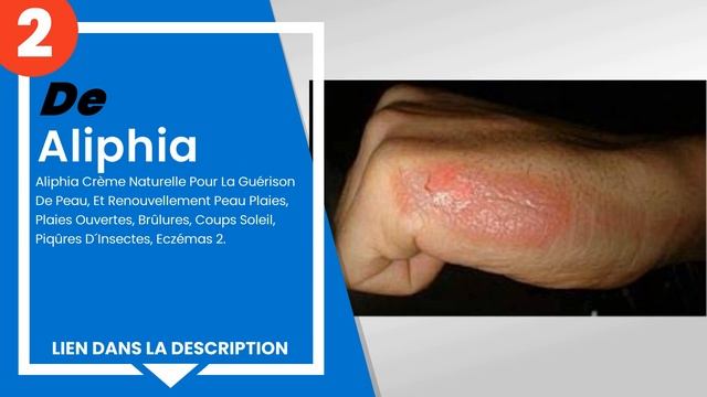 Les 3 meilleures crèmes pour la dermatite atopique смотреть онлайн