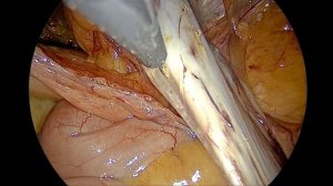 Правосторонняя пахово-мошоночная грыжа больших размеров. Лапароскопическая герниопластика (ТАРР).