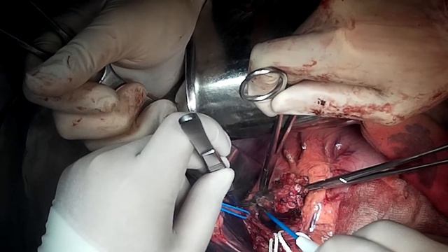 диссекция печеночно-двенадцатиперстной связки_1 смотреть онлайн