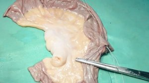 Серия 9. Кишечный анастомоз бок в бок