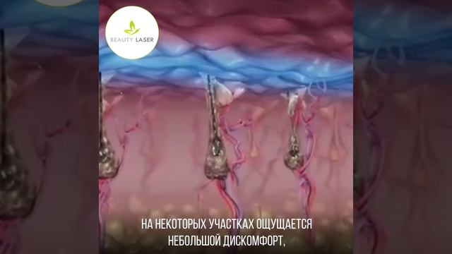 Лазерная эпиляция в салоне Beauty Laser Чернигов смотреть онлайн