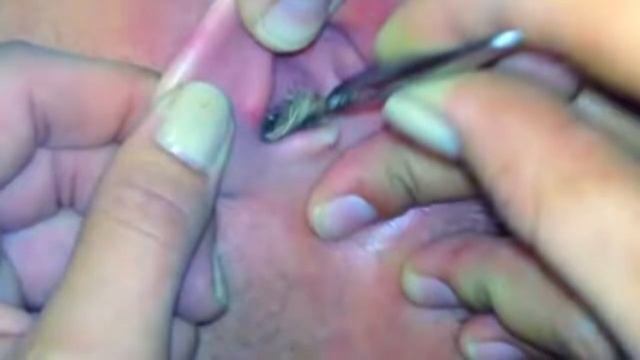 Что делать, если в ухо залезло насекомое? смотреть онлайн