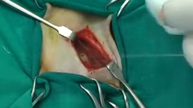 Bulla Osteotomi (Bulla Osteotomy) смотреть онлайн