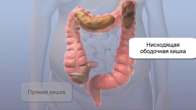 Толстая и прямая кишка | Очищение кишки человека смотреть онлайн
