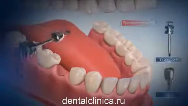 Лечение зубов красивая улыбка виниры коронки протезирование имплантация приятные цены medium5 смотреть онлайн