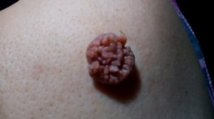 ПАПИЛЛОМАТОЗНЫЙ НЕВУС - ЛЕЧЕНИЕ. День 22