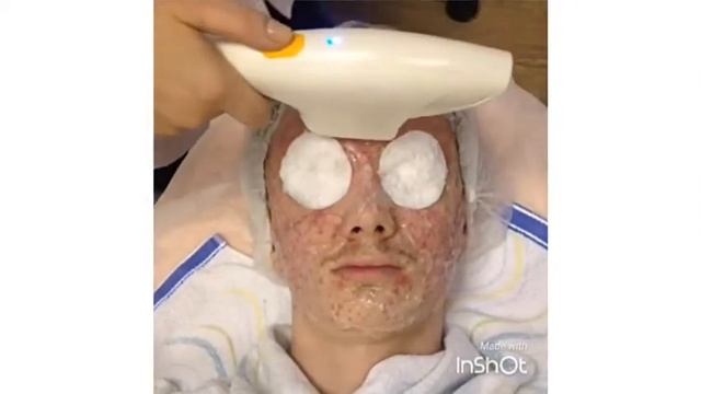 Как избавиться от акне ? смотреть онлайн